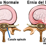 Ernia del disco